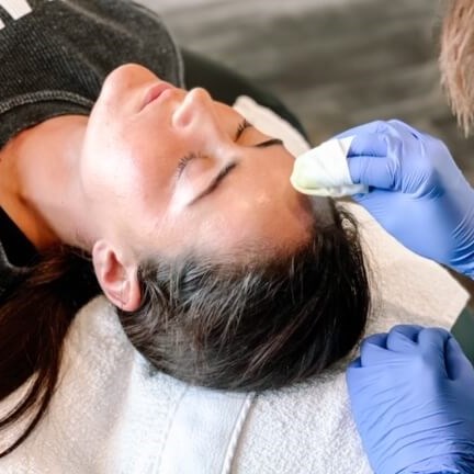 Chemical Peel